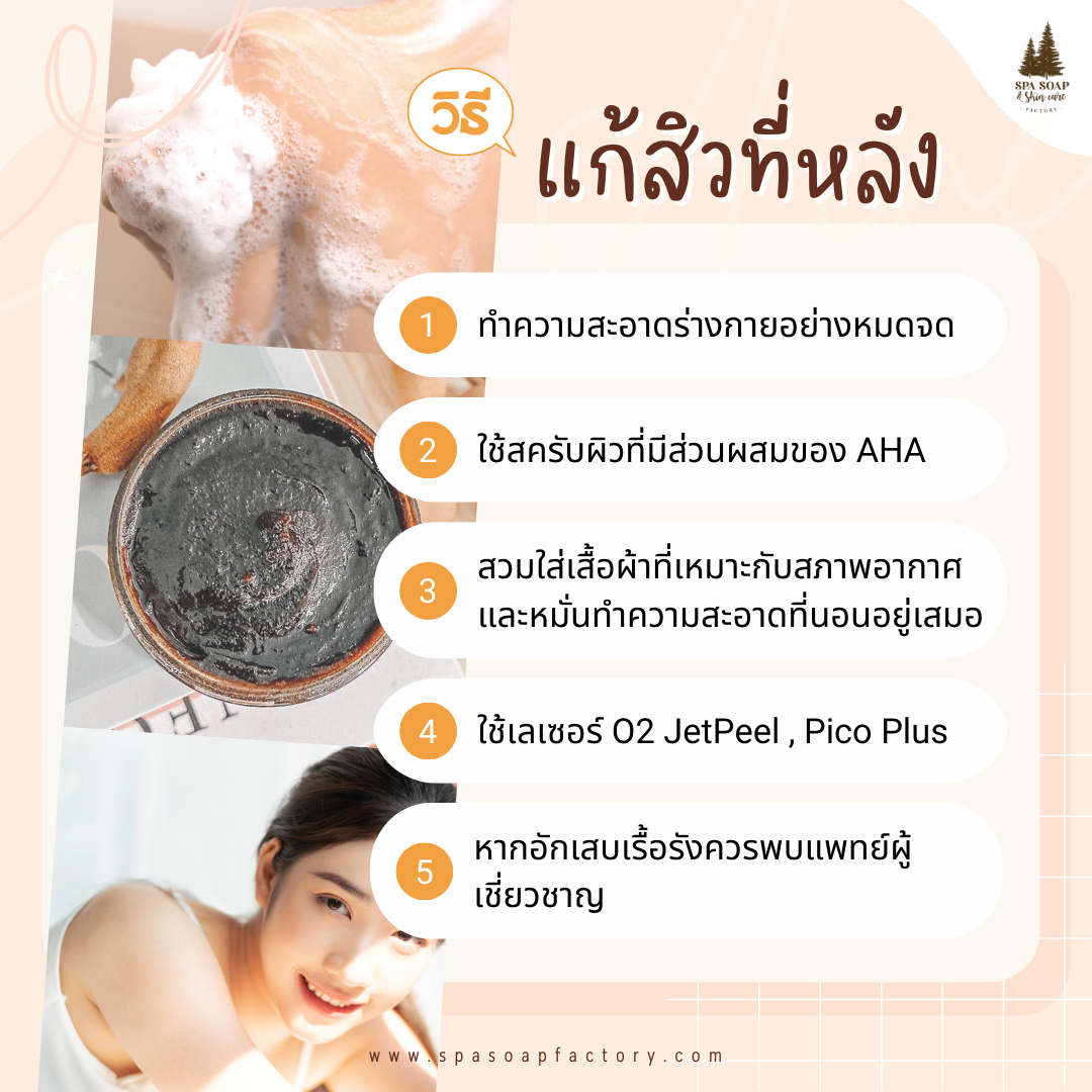 5 วิธี ทำยังไง? สิวหลังหายเกลี้ยง ไม่กลับมาเป็นซ้ำ