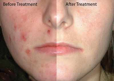 (พร้อมส่ง) Mederma® Advanced Scar Gel - เจลรักษาแผลเป็น mederma จาก usa ขนาด 50 กรัม