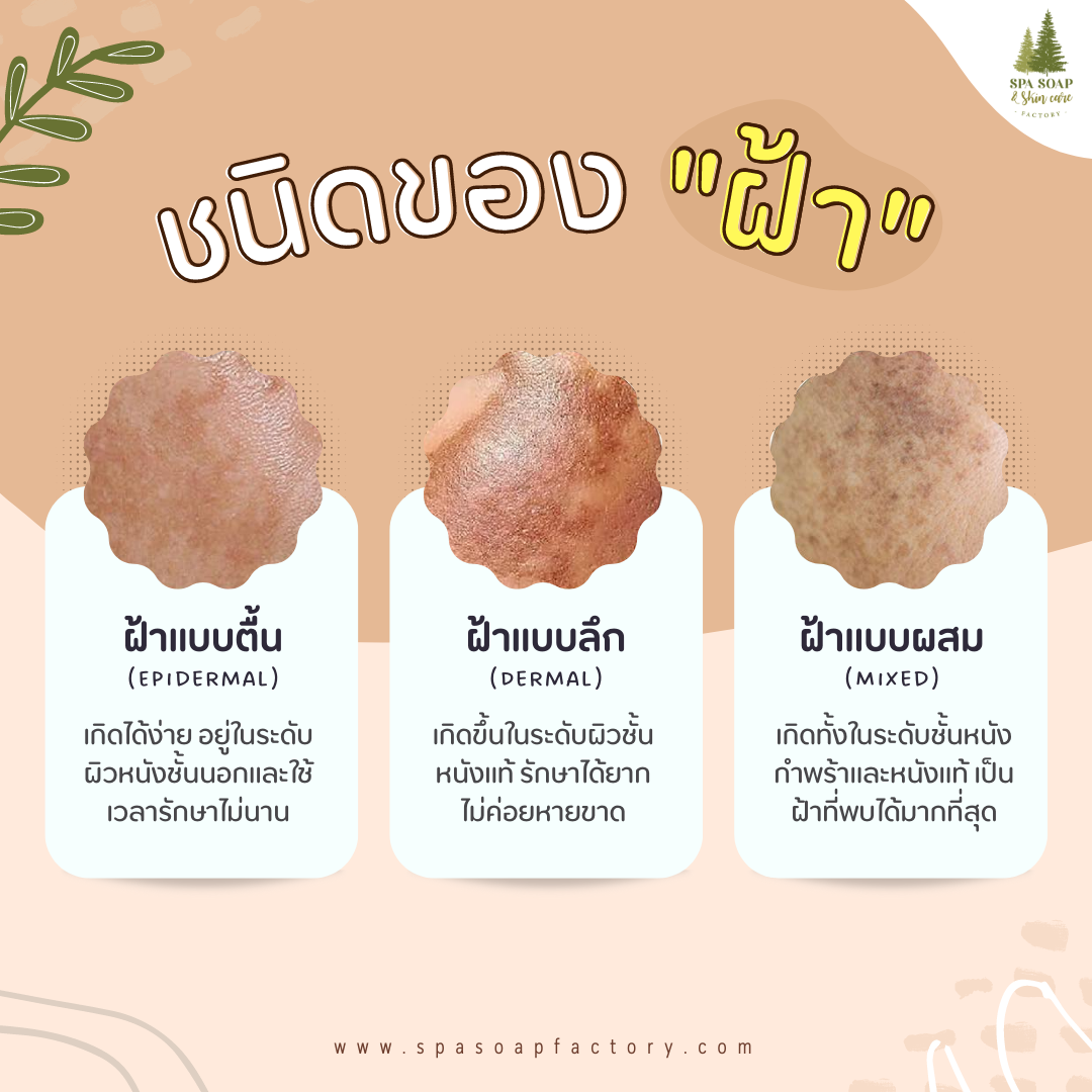 รู้จัก "ฝ้า" ปัญหาที่ไม่อยากให้เกิดบนหน้าของเรา