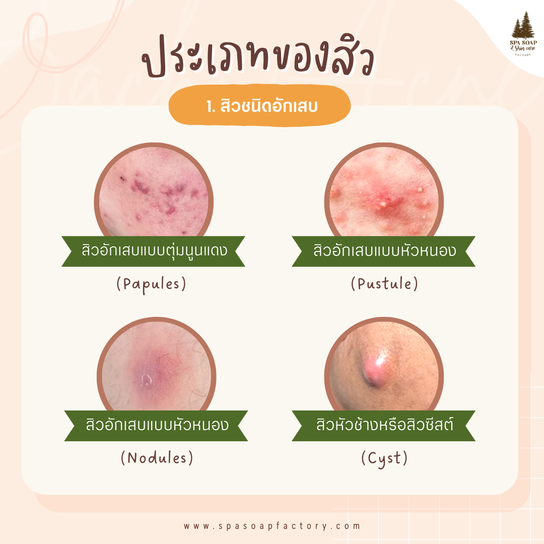 5 วิธี ทำยังไง? สิวหลังหายเกลี้ยง ไม่กลับมาเป็นซ้ำ