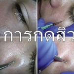 การกดสิว