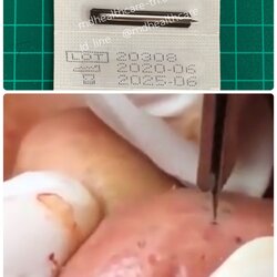 ที่เจาะสิวอุดตัน ก่อนกดสิว (5ชิ้น)